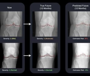 AI Predicts Osteoarthritis Progression