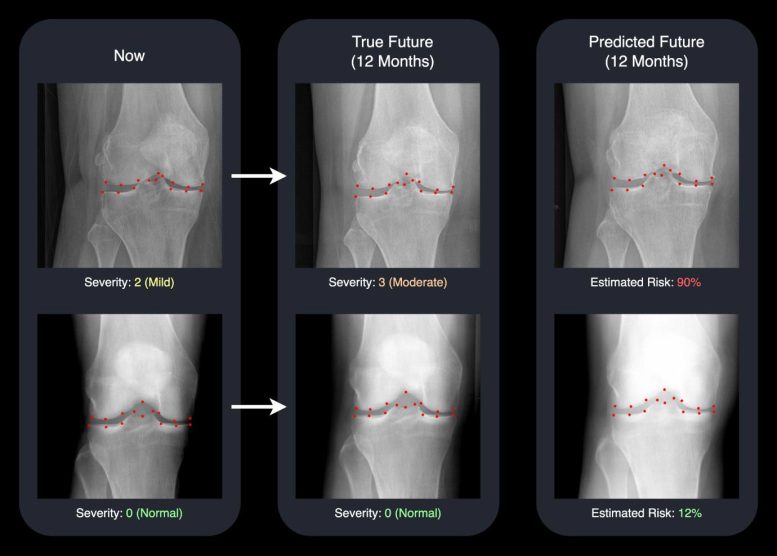 AI Predicts Osteoarthritis Progression