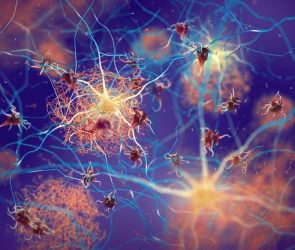 Amyloid Plaques Neurons Alzheimer's Dementia