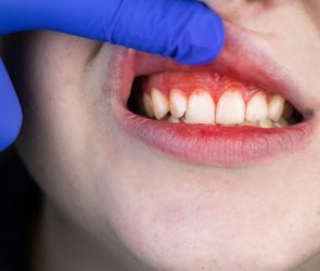 Bleeding Gums Gum Disease