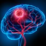 Brain Cancer Blood Vessels Tumor