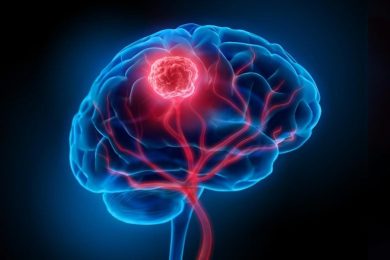 Brain Cancer Blood Vessels Tumor