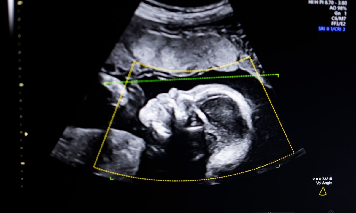 Biotics AI, Battlefield 2023, gains FDA approval for its AI-powered fetal ultrasound product 