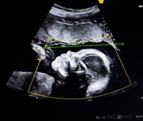 Biotics AI, Battlefield 2023, gains FDA approval for its AI-powered fetal ultrasound product 