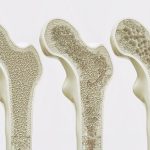 Hip Bones Osteoporosis Stages