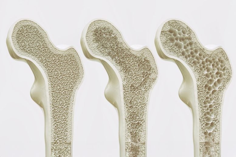 Hip Bones Osteoporosis Stages
