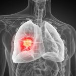 Lung Cancer Science Photo