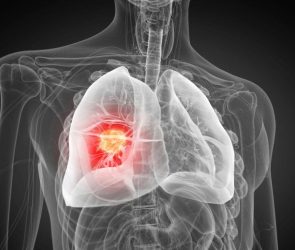 Lung Cancer Science Photo