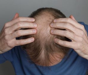 Mature Balding Man Top of Head Close Up