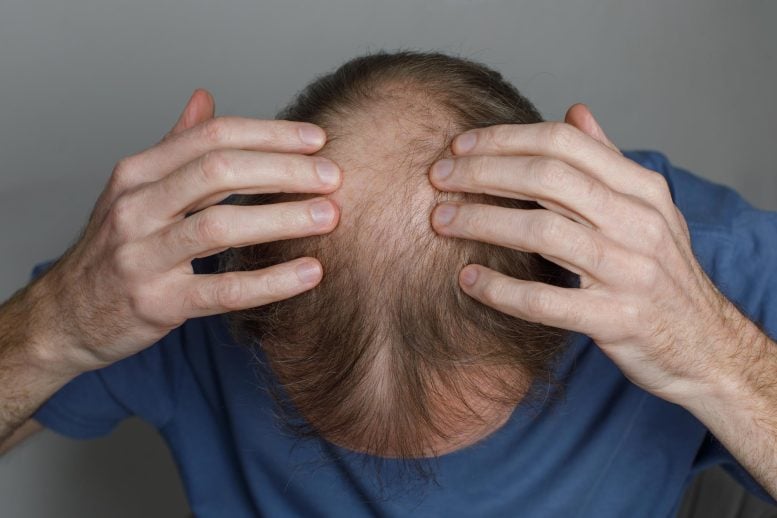 Mature Balding Man Top of Head Close Up
