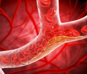 Narrowed Blood Vessel Cholesterol Plaque Buildup