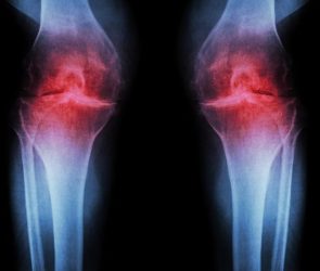 Osteoarthritis Knee