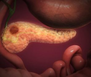 Reconstructed Image of Pancreatic Adenocarcinoma