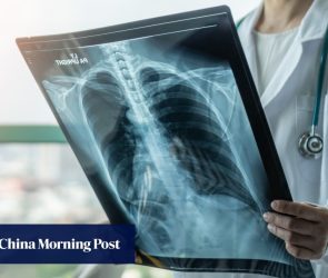 Malaysia risks under-reporting of TB cases as ‘slow-burn epidemic’ persists