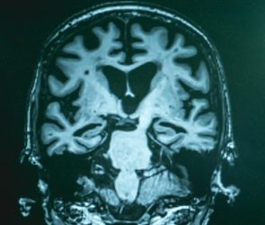 MRI Brain Scan Alzheimers Dementia Close