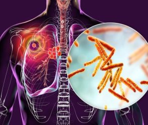 Primary Lung Tuberculosis
