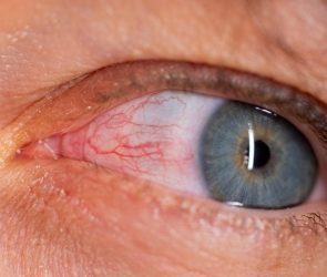 Red Eye Burst Blood Vessels Subconjunctival Hemorrhage Conjunctivitis