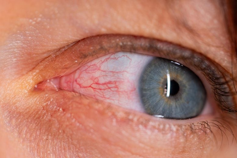 Red Eye Burst Blood Vessels Subconjunctival Hemorrhage Conjunctivitis
