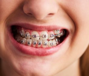 Why our ancestors had straight teeth without braces