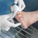 Bandaging Infected Diabetic Foot Wound