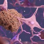 Brain Dementia Neurons Amyloid Plaque Alzheimer's Disease