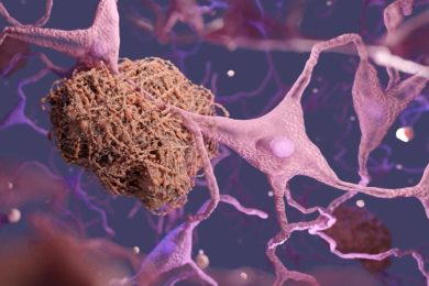 Brain Dementia Neurons Amyloid Plaque Alzheimer's Disease