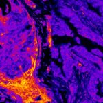 Breast vs Lung Cancer Metabolic Signal