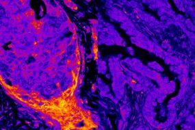 Breast vs Lung Cancer Metabolic Signal