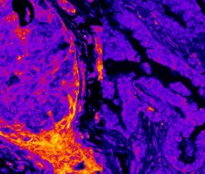 Breast vs Lung Cancer Metabolic Signal