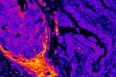 Breast vs Lung Cancer Metabolic Signal