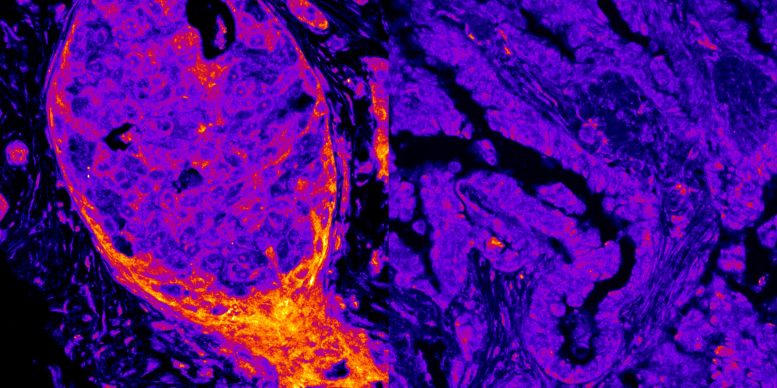 Breast vs Lung Cancer Metabolic Signal