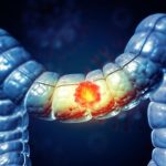 Colon Cancer Large Intestine