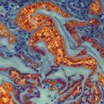 Key Proteins in Pancreatic Cancer Xenografts