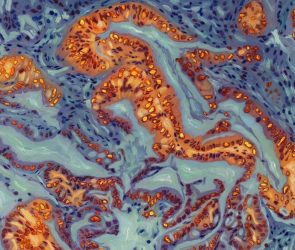 Key Proteins in Pancreatic Cancer Xenografts