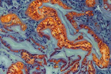 Key Proteins in Pancreatic Cancer Xenografts