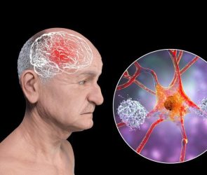 Senior Man Dementia Amyloid Plaques Neurofibrillary Tangles Brain Neurons