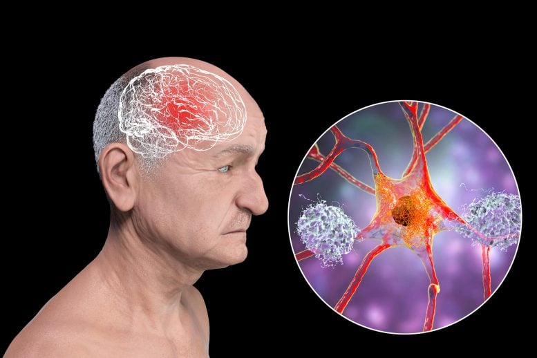 Senior Man Dementia Amyloid Plaques Neurofibrillary Tangles Brain Neurons