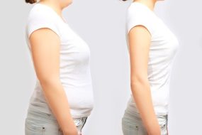 Young Woman Obesity Weight Loss Before and After